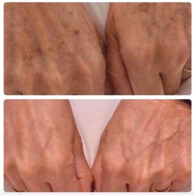 Expigment 4%- hydroquinone 30G