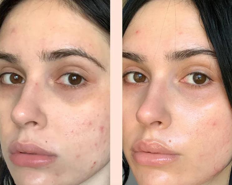 Expigment 4%- hydroquinone 30G